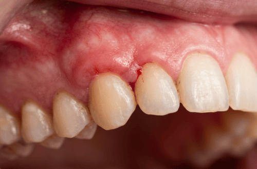 gencive avec rougeur et inflammation